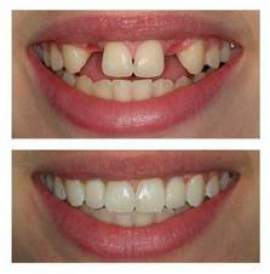 missing teeth tooth before implant replace single replacing implants dental crown